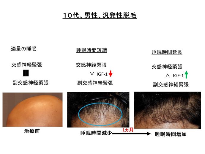 円形脱毛症　病院
